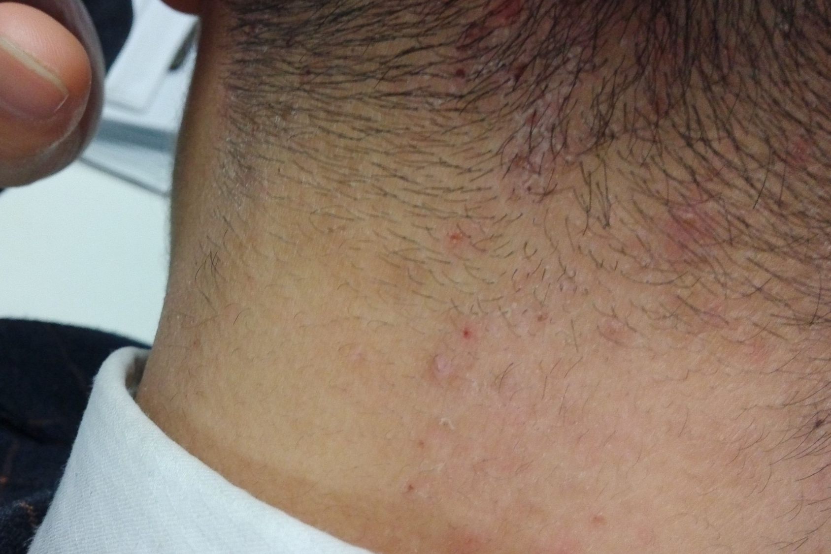 染发引起皮肤过敏