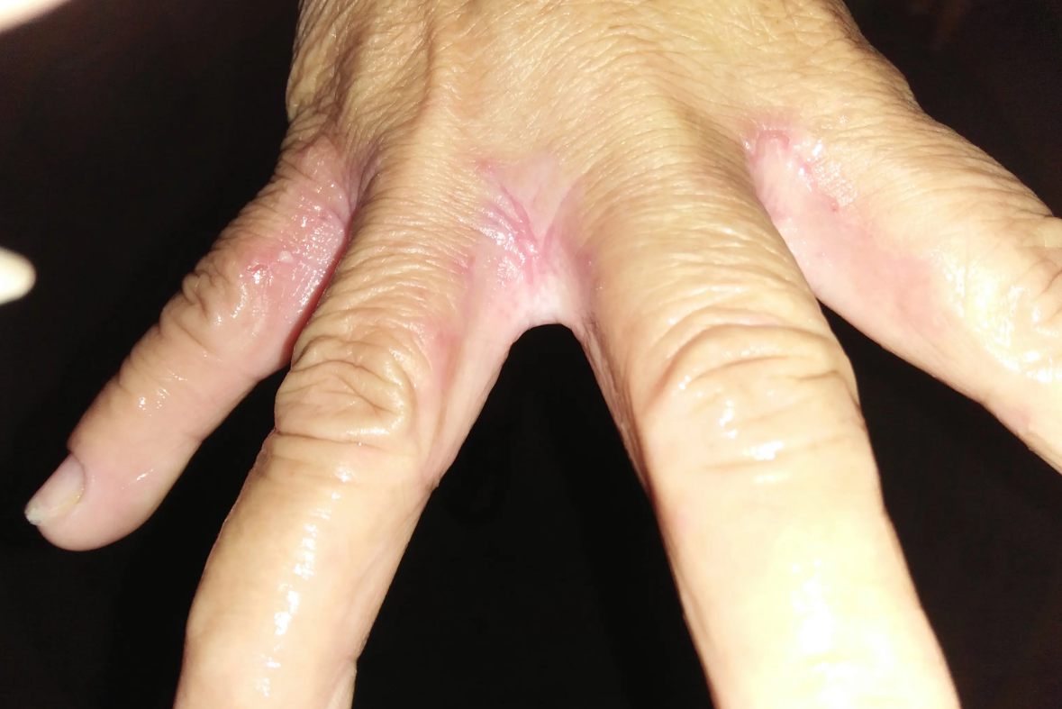 手部湿疹