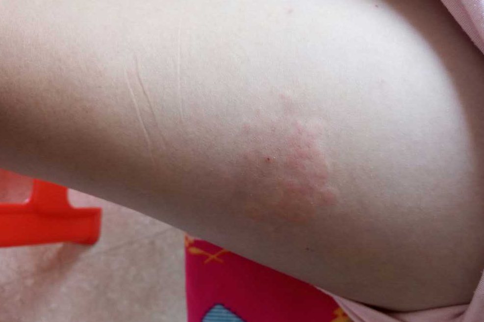 湿疹初期