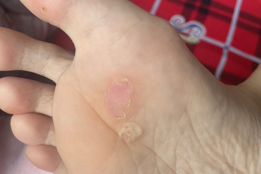 鸡眼好了以后的皮肤