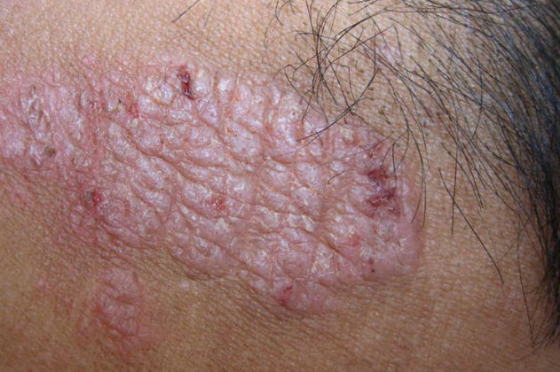 慢性单纯性苔藓