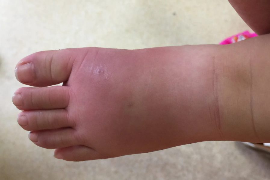 皮肤局部过敏反应