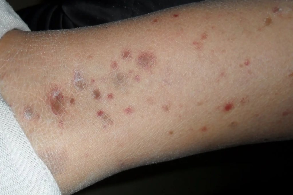 色素性紫癜性皮炎