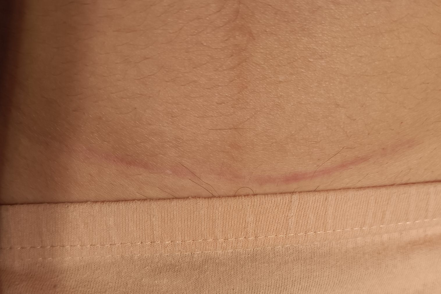 剖腹产4个月疤痕