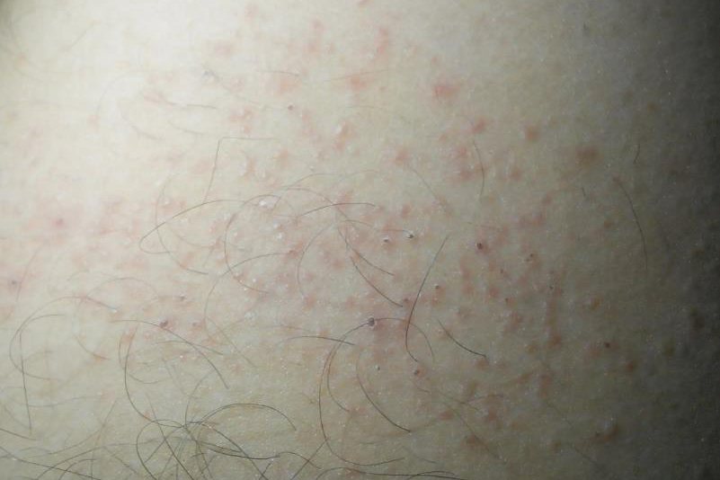 大腿根部红斑湿疹