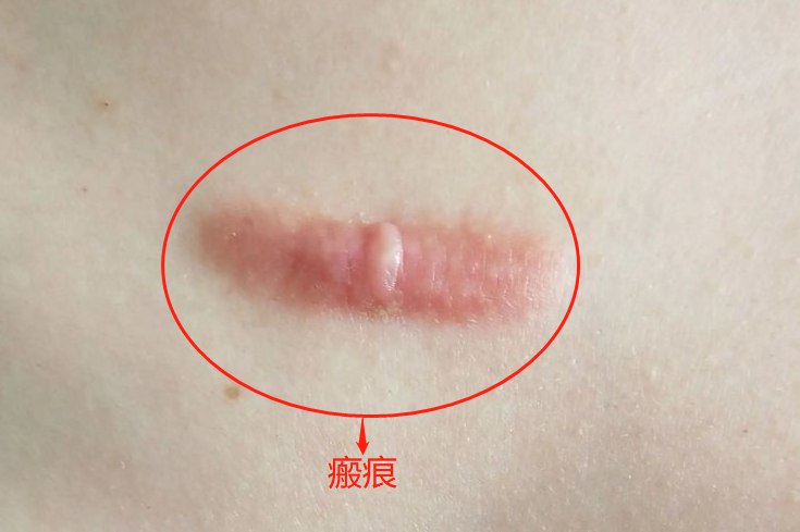 瘢痕图片