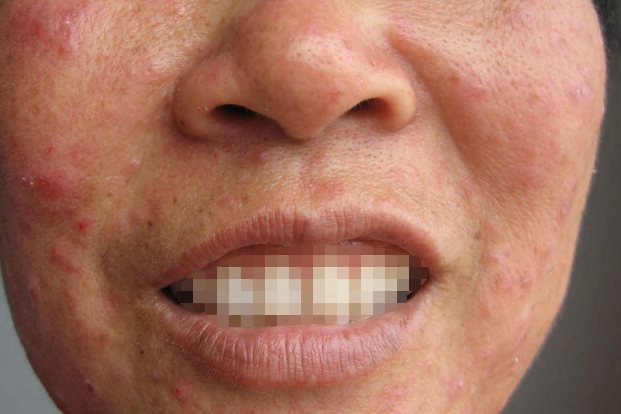 激素依赖和反跳现象