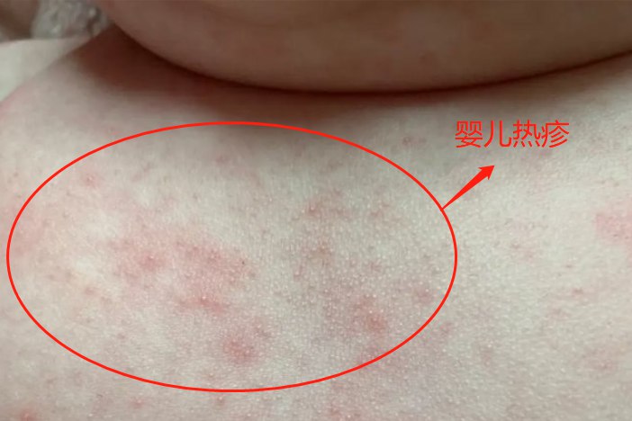 婴儿热疹图片