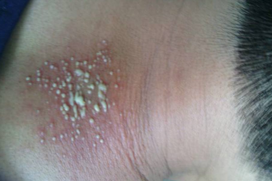 飞蛾粉碰到皮肤引起接触性皮炎