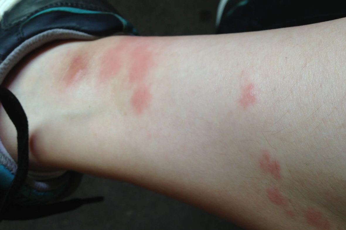 潮虫咬人后皮肤