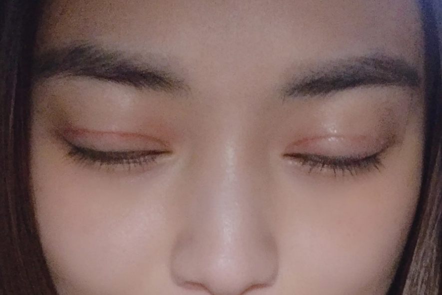 割双眼皮3个月疤痕图片