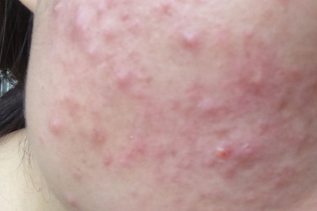 面部轻度真菌感染