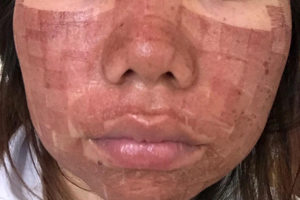 点阵激光打完脸部效果图