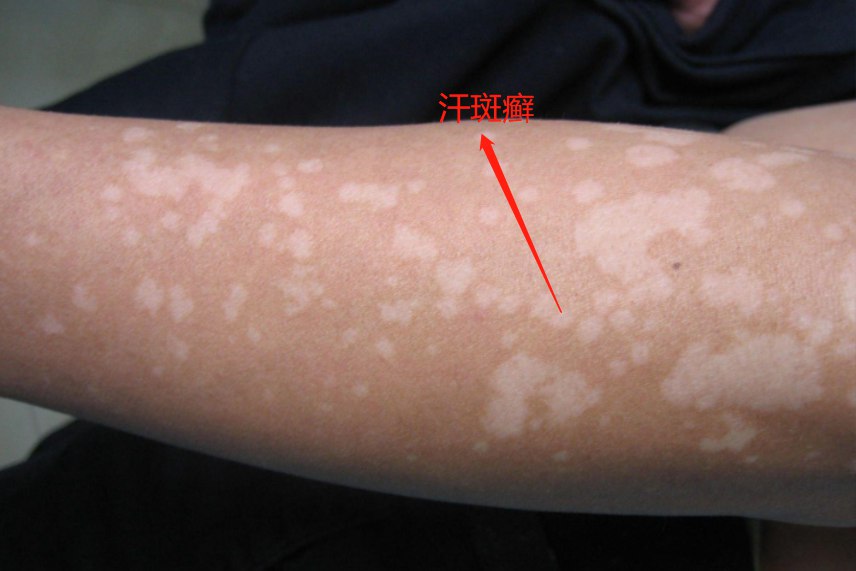 汗斑癣图片