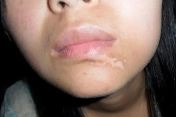 嘴唇白色糠疹图片