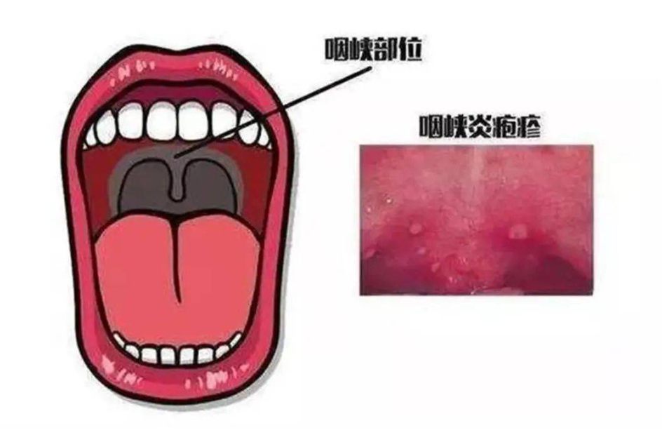 疱疹性咽峡炎