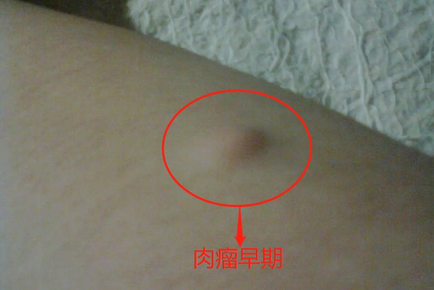 肉瘤早期图片
