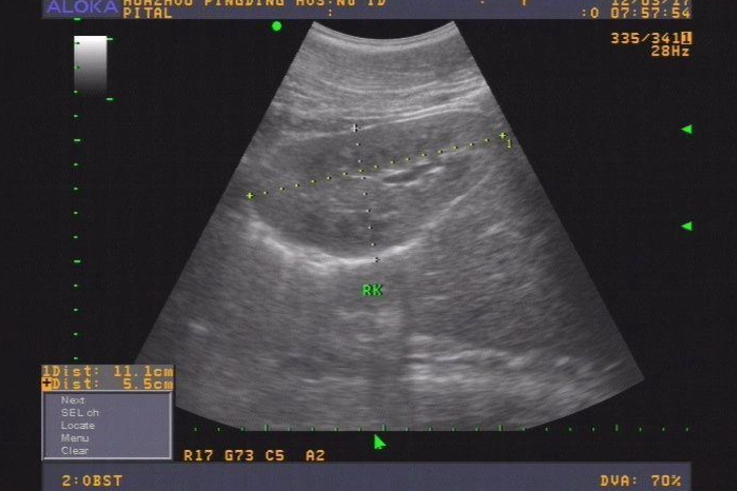 双角子宫超声图片