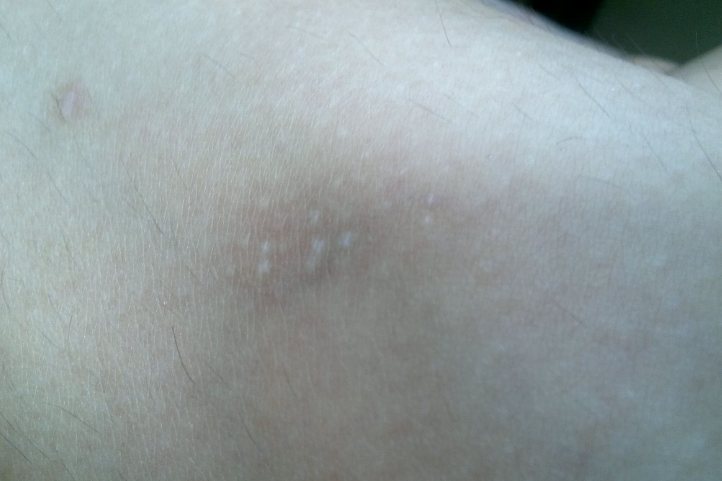 蚊子叮咬后留下色素沉着斑