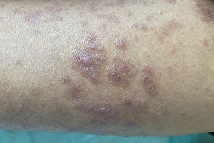 皮肤苔癣样变图