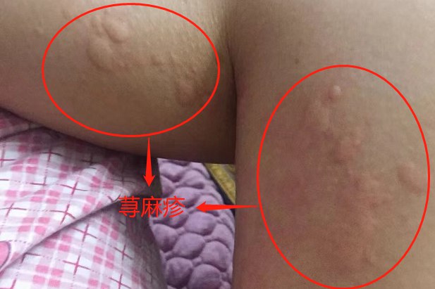 荨麻疹