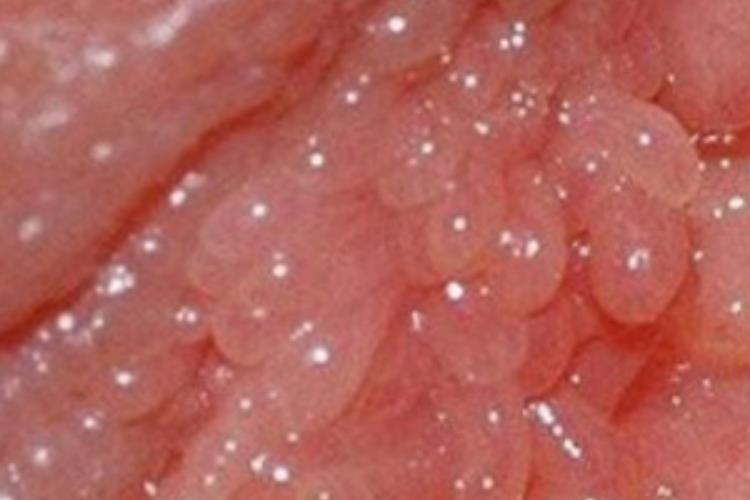 女性绒毛状假性疣