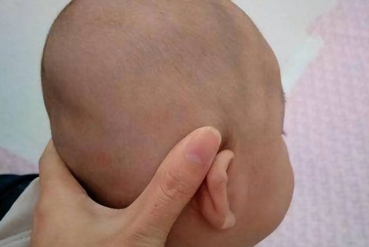 婴儿头部凹陷图