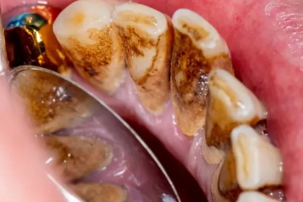 黑色牙菌斑图片