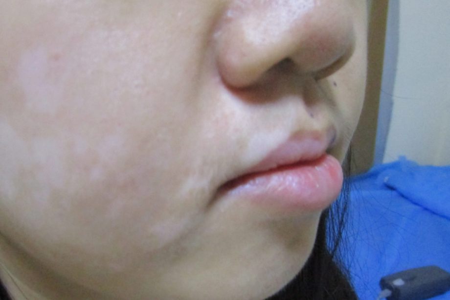 白癜风嘴唇变白