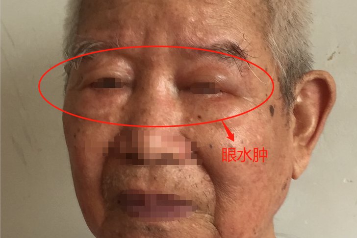 眼睑水肿图片