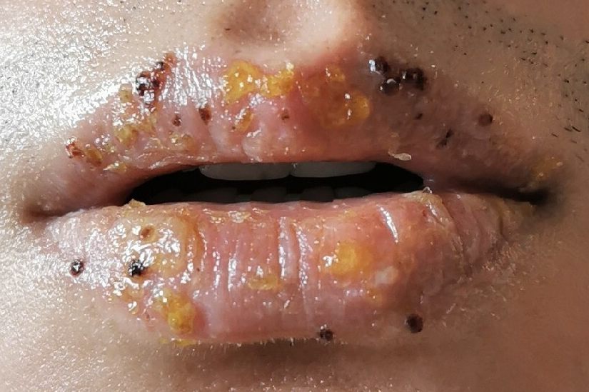 皮脂腺异位症激光治疗后