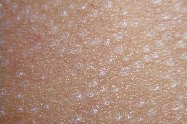 花斑癣早期症状