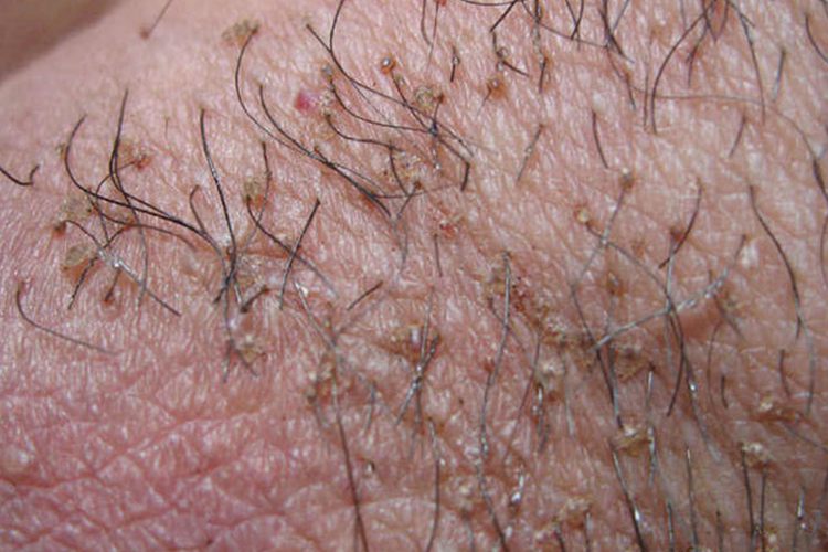 继发性毛囊炎图