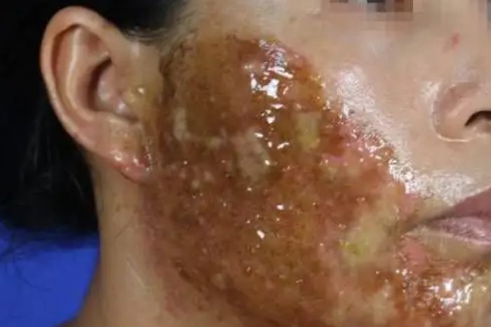 脸部溃烂图片