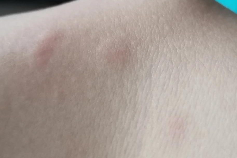 臭虫咬的初期症状