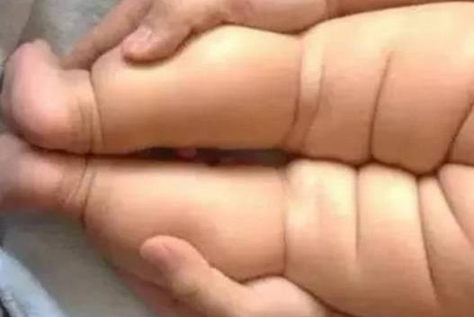 髋关节发育不良