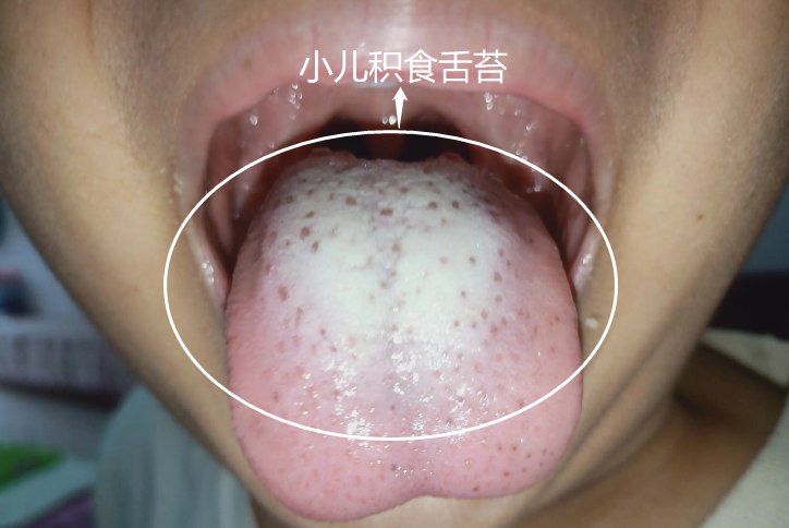 小儿积食舌苔图片