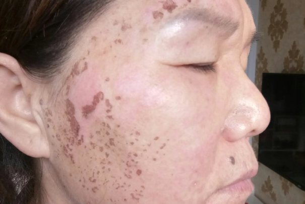 激光去斑后掉痂