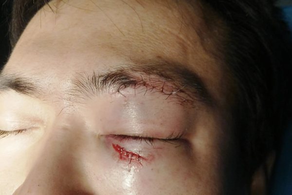 眼睑缝合手术后图片