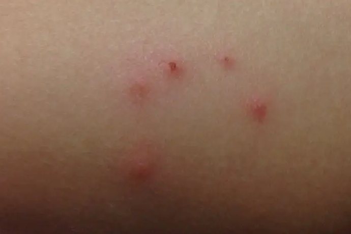 被毒蚊子咬的症状