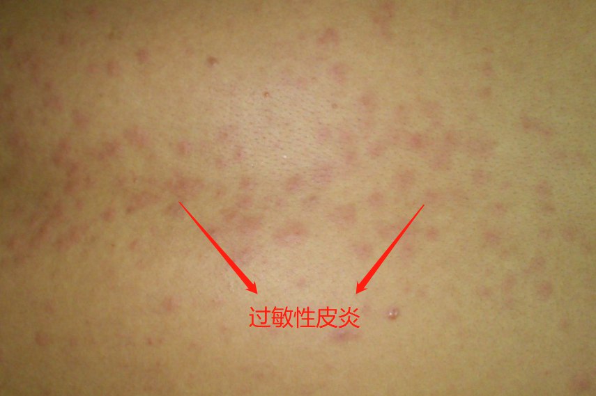过敏性皮炎图片