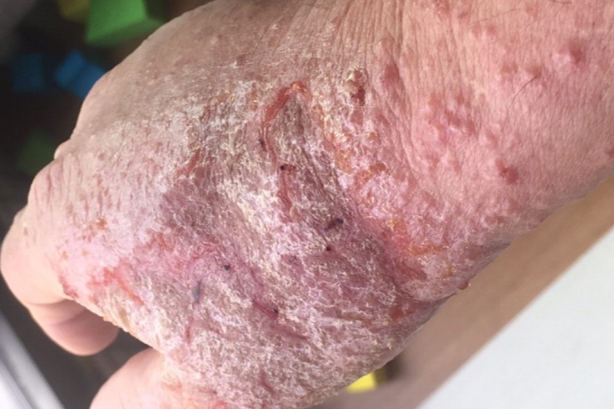 湿疹用炉甘石后结痂