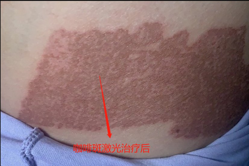 咖啡斑激光治疗