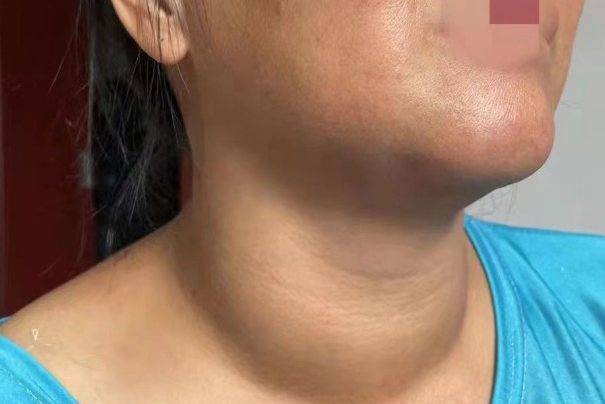 甲状腺肿大二度