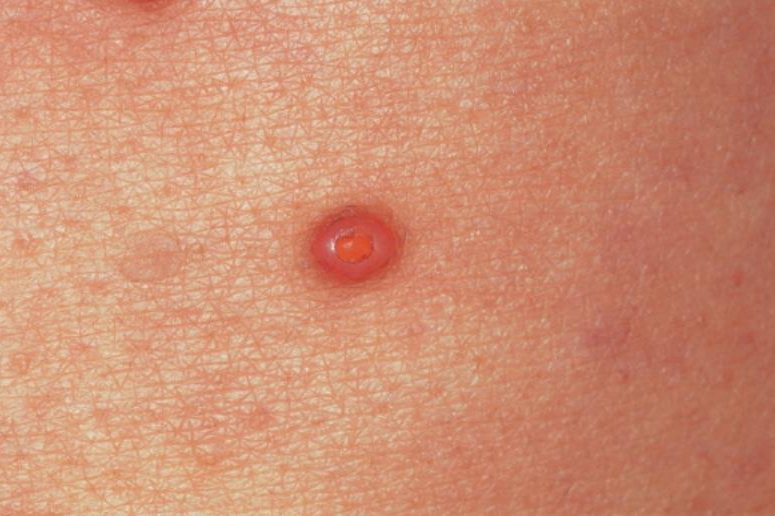 初期传染性软疣