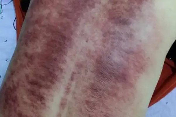 亚健康刮痧后背图