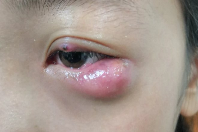 外睑腺炎