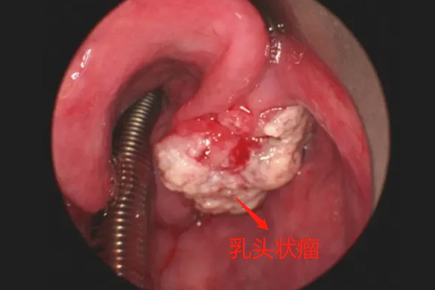 乳头状瘤疣图片