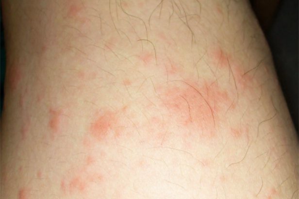 牛奶过敏湿疹图片