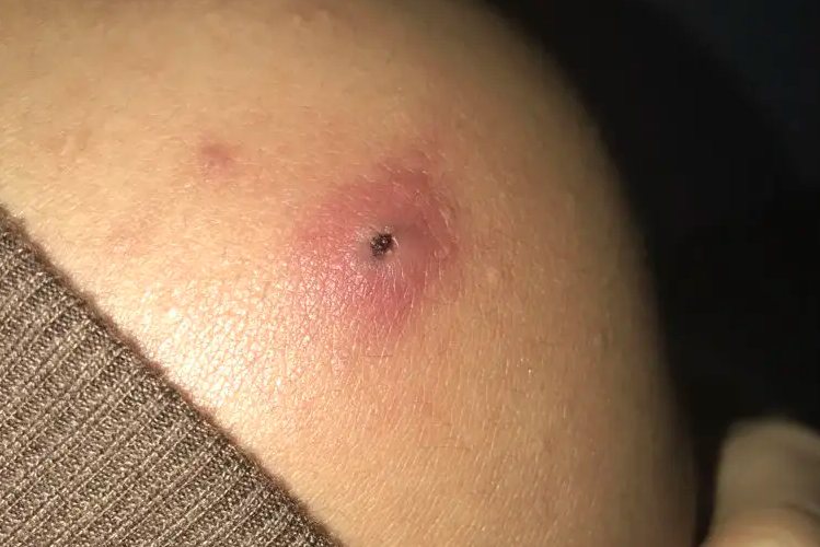 疖子结痂后图片